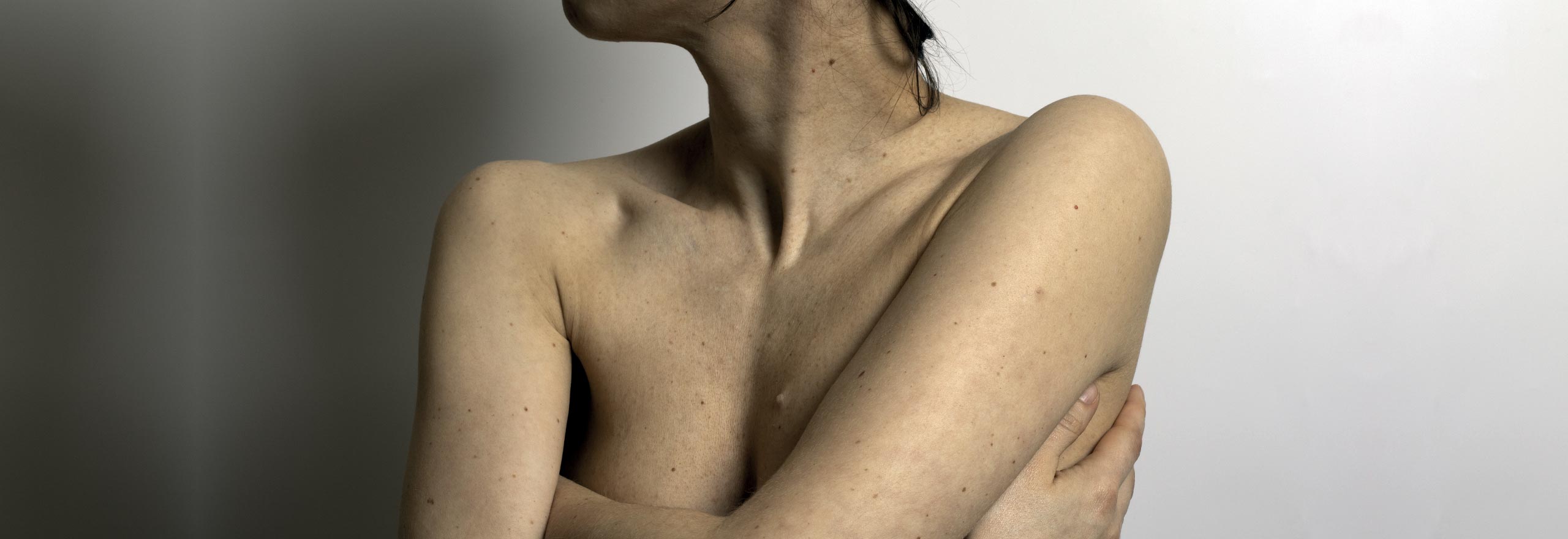 woman with crossed arms having mole checkup